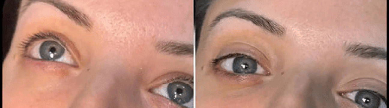Dermal Fillers